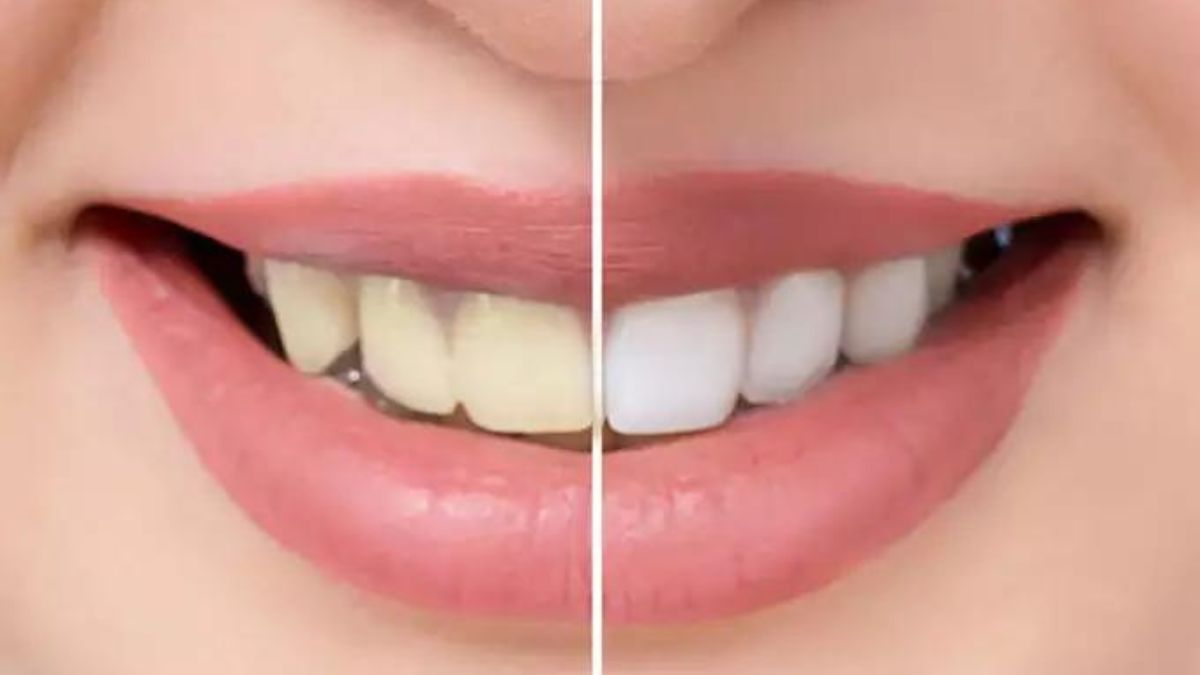 How To White Yellow Teeth